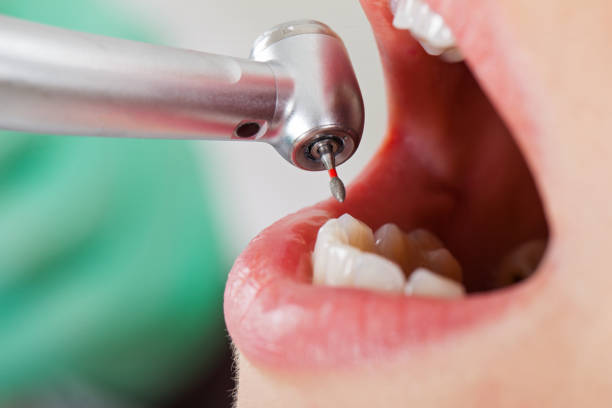 Best Emergency Tooth Extraction in Lexington, MS